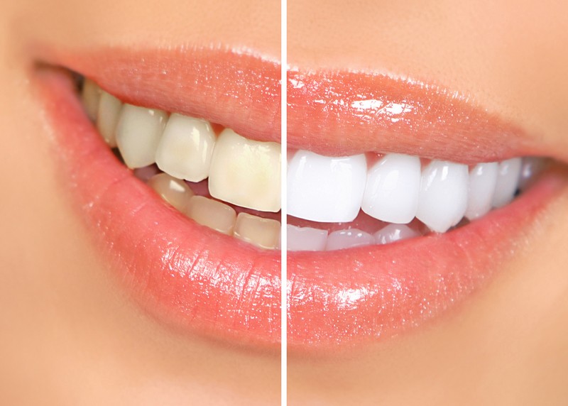 Teeth Whitening  Vienna, VA 