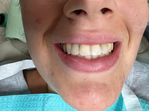 After - Naturally missing lateral incisors replaced by implant-crowns